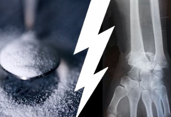 Cosa c’entra lo zucchero con l’osteoporosi?